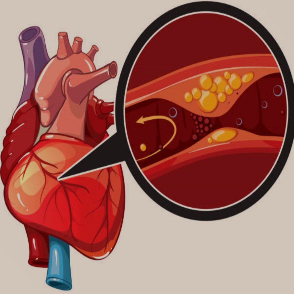 What causes heart disease? - Heart and Vascular Centre