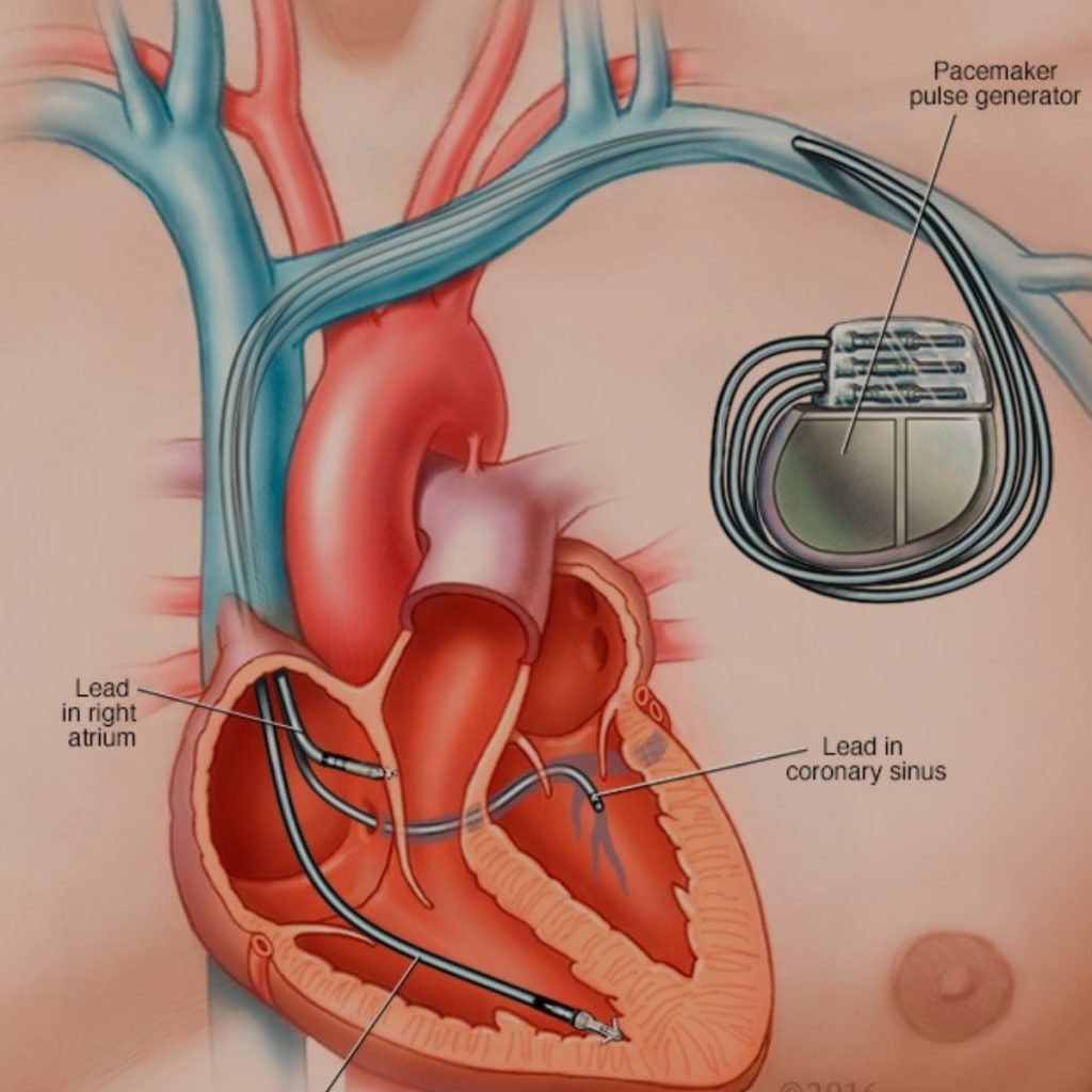 what-is-a-pacemaker-heart-and-vascular-centre